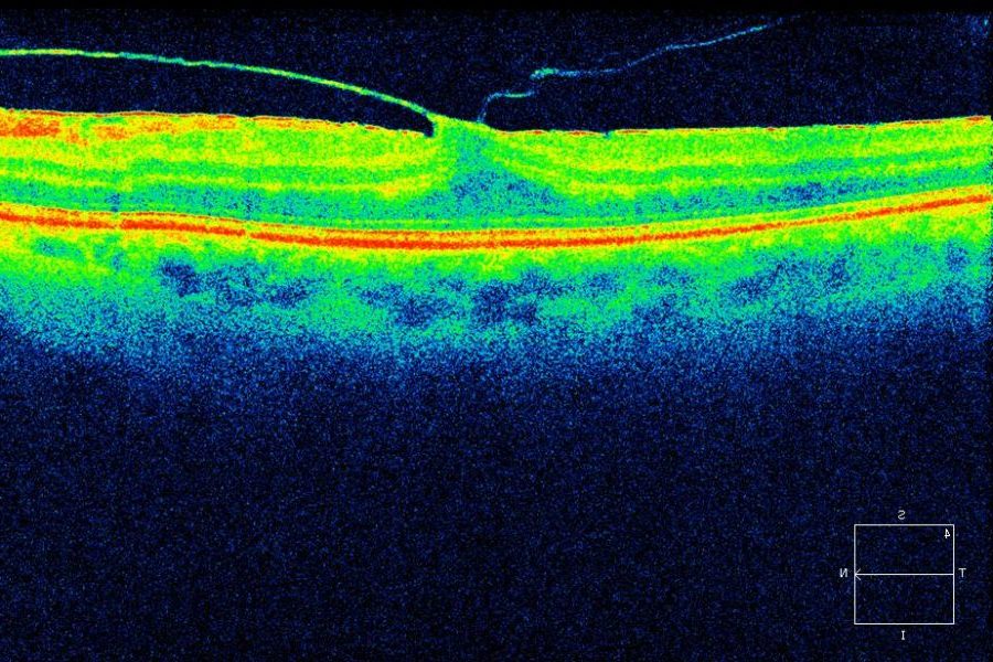 Ocriplasmina como alternativa a la tracción vitreomacular