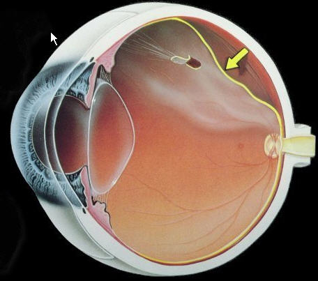 DESPRENDIMIENTO DE GEL VITREO.CAUSAS Y CONSECUENCIAS.