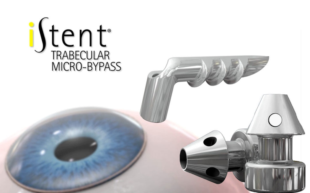 I-Stent. Nuevo dispositivo para cirugía combinada de Glaucoma y Catarata.