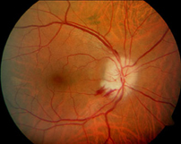 Neuropatía optica isquémica