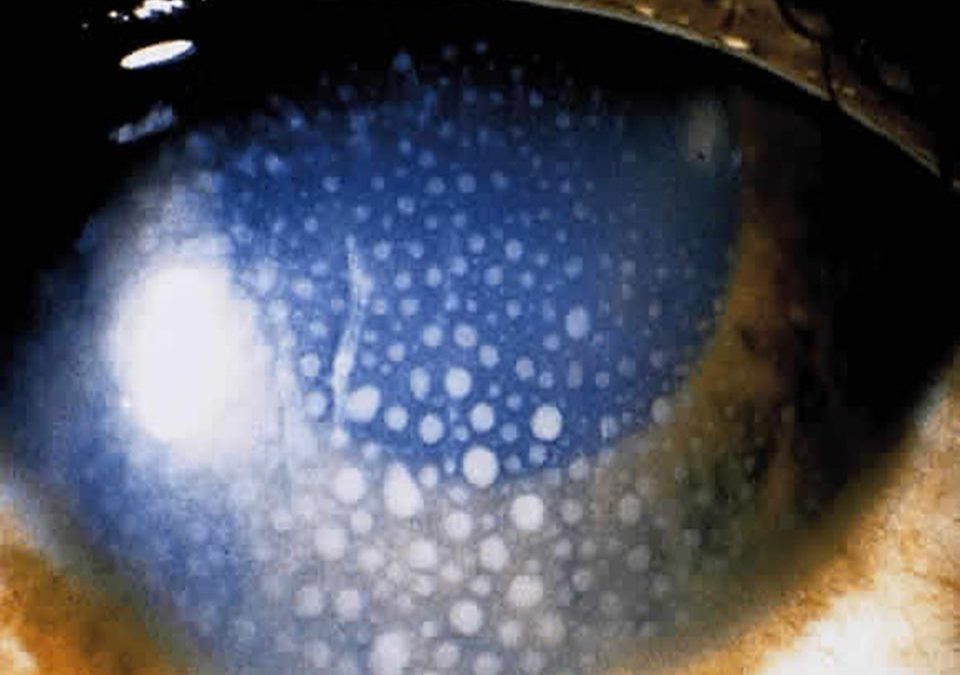 uveitis-anterior-clinica-ocular-marbella