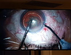 cirugia-ocular-marbella