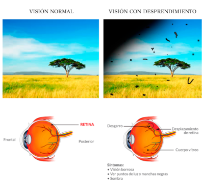 desprendimiento-de-retina-doctora-carretero-marbella