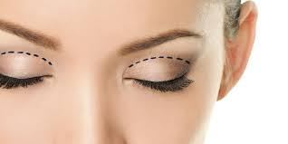 blefaroplastia-marbella