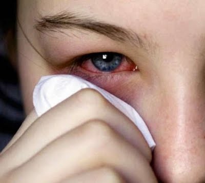 queratoconjuntivitis-epidemica-marbella