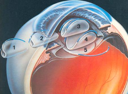 ACTUALIZACION EN LENTES INTRAOCULARES .